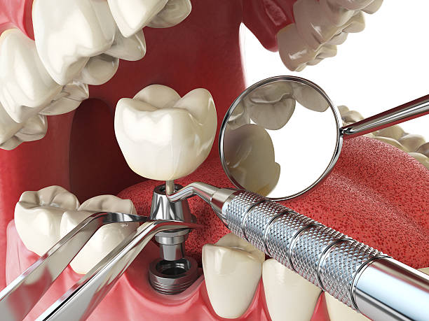 Best Emergency Wisdom Tooth Extraction in Bellevue, IL